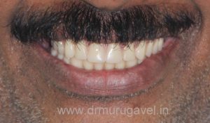 SMILE DESIGNING IN CHENNAI