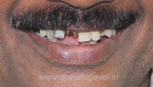 SMILE DESIGNING IN CHENNAI