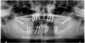 SMILE DESIGNING IN CHENNAI