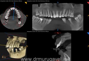 GET FIXED TEETH AND CONFIDENT SMILE IN JUST 3 DAYS