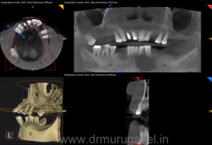 SMILE DESIGNING IN CHENNAI