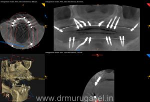 SMILE DESIGNING IN CHENNAI