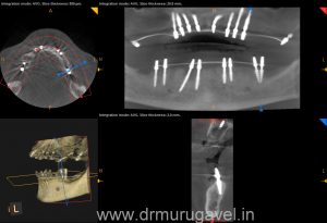 SMILE DESIGNING IN CHENNAI