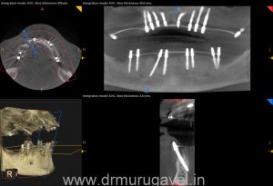 SMILE DESIGNING IN CHENNAI