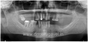 SMILE DESIGNING IN CHENNAI