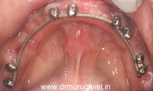 intra oral welding