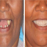 smile designing with basal implants