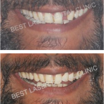 immediate replacement for tooth with periapical lesion