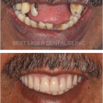 removable denture replacement with basal implants