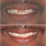 missing front teeth replacement with basal implants