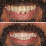 multiple missing and mobile teeth replacement