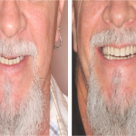 esthetic smile with basal implants