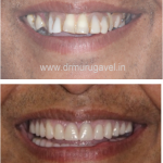 restoring smile and chewing