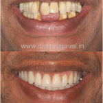 GET FIXED TEETH AND CONFIDENT SMILE IN JUST 3 DAYS